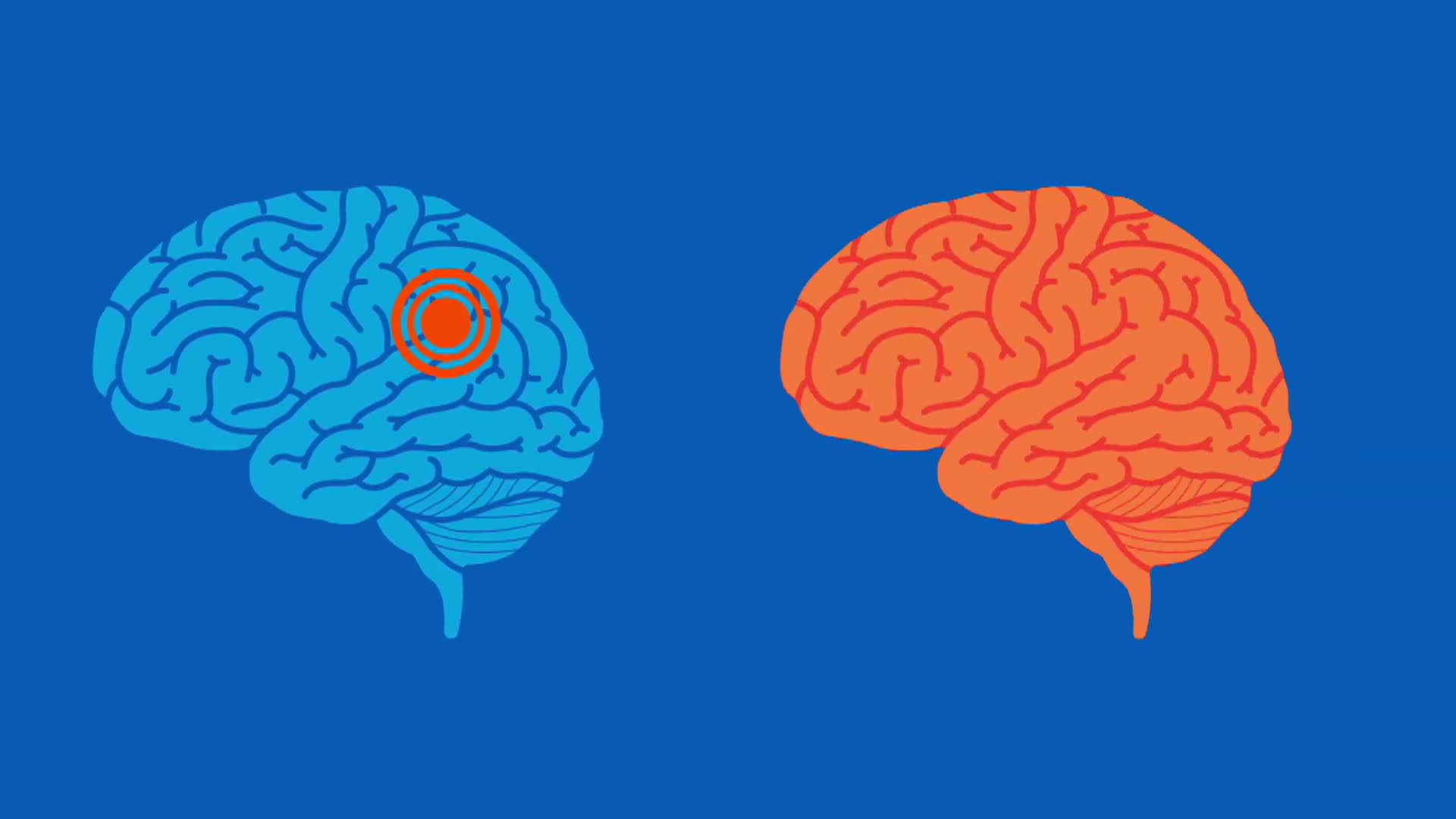 What is Epilepsy A Mayo Clinic expert explains